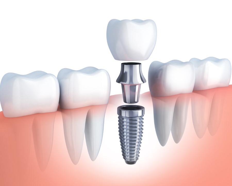 implanty zębów Kalisz