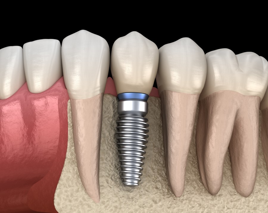 Implanty zębów Kalisz